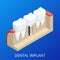 Isometric Tooth human implant. Dental concept. Human teeth or dentures. 3d illustration Isolated. Realistic vector