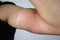 Japanese man\'s arm with rough skin