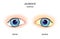 Jaundice. Comparison and difference of normal eye, and eye with icterus