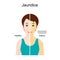 Jaundice. The Comparison between Healthy person and person with Icterus