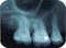 jaw x ray of left uper teeth