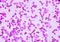 JBlood smear under microscopy showing on Adult acute myeloid leukemia AML is a type of cancer in which the bone marrow makes abn