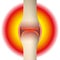 Joint Pain Rheumatism Synovial Joint