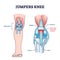 Jumpers knee or patellar tendonitis tendon bone inflammation outline diagram