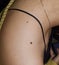 Junctional nevus or double moles at shoulder of Southeast Asian, Myanmar young woman
