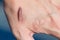 Keloid scar Hypertrophic Scar on man hand skin after accident. keloidal scar on wrist skin cause by surgery in car accidental