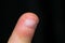 Kid finger peak on black background with exfoliated skin around the nail