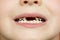 Kid patient open mouth showing cavities teeth decay. Close up of unhealthy baby teeth. Dental medicine and healthcare - human