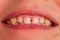 Kid patient open mouth showing cavities teeth decay. Close up of unhealthy baby teeth. Dental medicine and healthcare - human