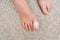 Kid teenager bare foot with a bandage on a toe, wounded toe or ingrown nail first aid