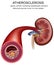 Kidney artery disease