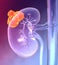 Kidney cancer, colorful medically 3D illustration