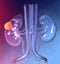 Kidney cancer, colorful medically 3D illustration