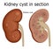 Kidney cyst in section