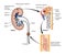 Kidney stone formation