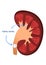 Kidney stones