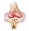 Knee - Advanced Osteoarthritis