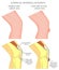 Knee bursitis_Superficial infrapatellar bursitis