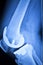 Knee joint implant x-ray test scan