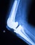 Knee joint implant x-ray test scan