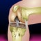 Knee joint infection, Joints and bones viral disorder, Arthritis and arthrosis, Knee trauma and injury, vector illustration