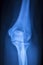 Knee joint meniscus x-ray test scan
