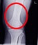 Knee joint.No fracture, dislocation , bony destruction