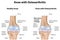 Knee Joint with Osteoarthritis