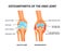 Knee Joint Ostheoarthritis Infographics