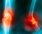 Knee joint pain