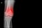 Knee joint x-ray  showing  fracture distal femur on red mark.and black background