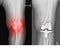 Knee joint x-ray showing osteoarthritis and bone regeneration, with total Knee Replacement