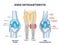 Knee osteoarthritis condition with skeletal bone degeneration outline diagram