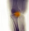 Knee X-ray, severe degenerative osteoarthritis