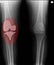 Knee x-rays image showing plate and fixation