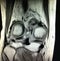 Knee rheumatoid arthritis severe synovitis mri