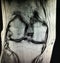 Knee rheumatoid arthritis severe synovitis mri