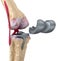 Knee and titanium hinge joint. Isolated