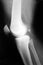 Knee xray