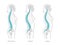 Kyphosis, lordosis flat vector illustration.