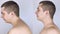 Before and after kyphosis. The man suffers from a curvature of the spine in the upper section. The cervical vertebrae bulge out an