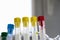 Laboratory blood test tube samples, research diagnoses, instruments and objects in the sterile table