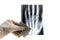 A laboratory worker in a glove holds an X-ray of a hand through one hundred dollars on a white background. Concept hospital and