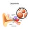 Labyrinthitis. inflammation of the inner ear and Herpes simplex virus that caused this disease
