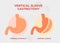 Laparoscopic Sleeve Gastrectomy, Vertical Gastrectomy, Weight loss surgery Vector Illustration of Stomach reduction surgery