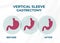 Laparoscopic Sleeve Gastrectomy, Vertical Gastrectomy, Weight loss surgery Vector Illustration of Stomach reduction surgery