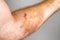 Large bruise on human arm