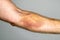 Large bruise on man arm