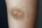 A large bruise on a woman`s leg.