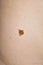 A large, cracked mole on a woman& x27;s belly.